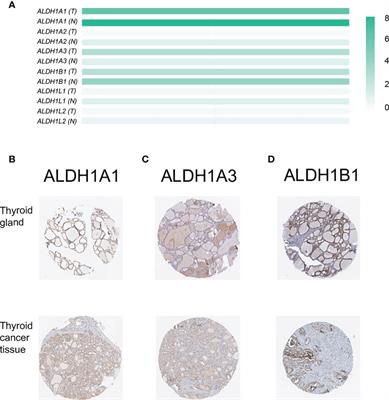 Transcriptional Expressions of ALDH1A1/B1 as Independent Indicators for the Survival of Thyroid Cancer Patients